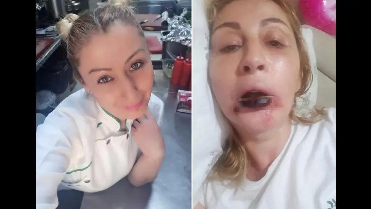 Yaptırdığı işlem sonrası dudağı &ccedil;&uuml;r&uuml;d&uuml;! 7 yıldır kabusu yaşıyor...