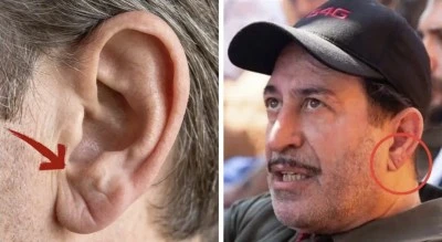 Cem Yılmaz'ın rahatsızlığı sonrası &ccedil;ok konuşuluyor: Kulak memesindeki &lsquo;Frank işareti&rsquo; ne anlama geliyor?